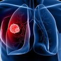 In Puglia ogni anno 2.000 nuovi casi di tumore del polmone
